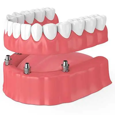 Implant-Supported Dentures at Carabelli Dental FL
