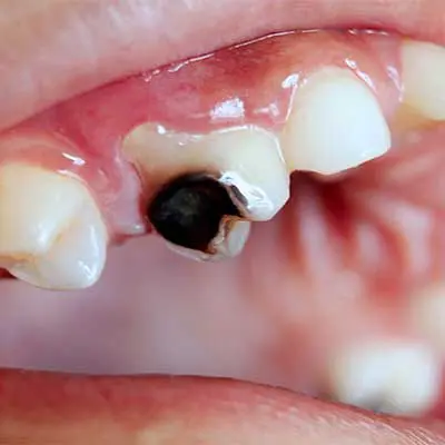 Extraction Reason: Severe tooth decay or infection