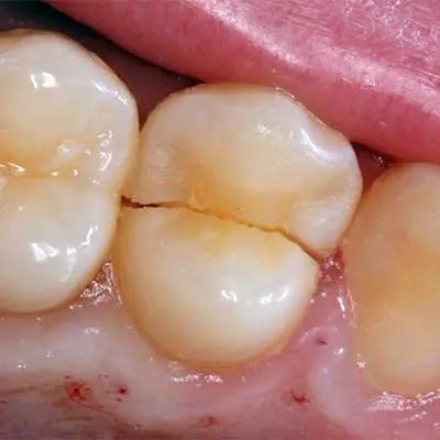 Extraction Reason: Broken or Damaged Teeth Beyond Repair