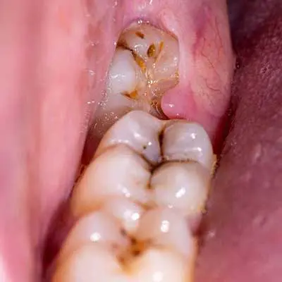Extraction Reason: Impacted or Partially Erupted Teeth