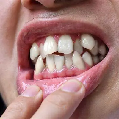 Extraction Reason: Overcrowding Before Orthodontic Treatment