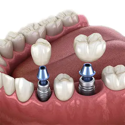 Extraction Reason: Preparation for Dental Implants or Restorations