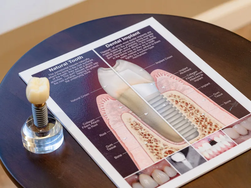 Dental model showing an implant, abutment and crown replacing a missing tooth.